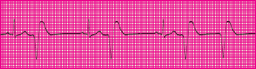 <p>Which rhythm is this?</p>