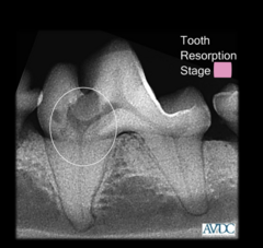 <p>what stage of tooth resorption is this?</p>