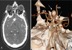 <p>berry aneurysm</p>