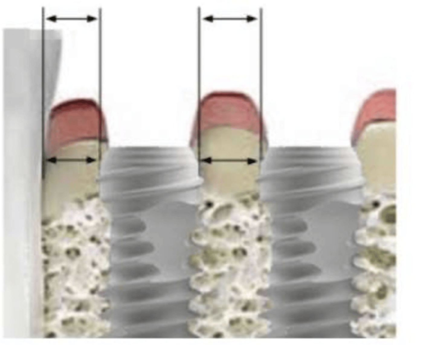 <p>How much space do we want between 2 implants?</p>