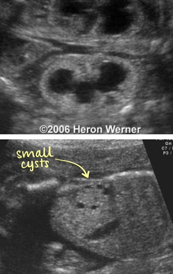 <ul><li><p>echogenic kidneys containing peripheral cortical cysts</p><ul><li><p>variable number/size of cysts</p></li></ul></li><li><p>renal size can be small or enlarged</p></li><li><p>if bilateral disease from bladder outlet obstruction</p><ul><li><p>thick-walled bladder; severe oligohydramnios </p></li></ul></li><li><p>early disease may show hydronephrosis/hydroureter</p></li></ul><p></p>