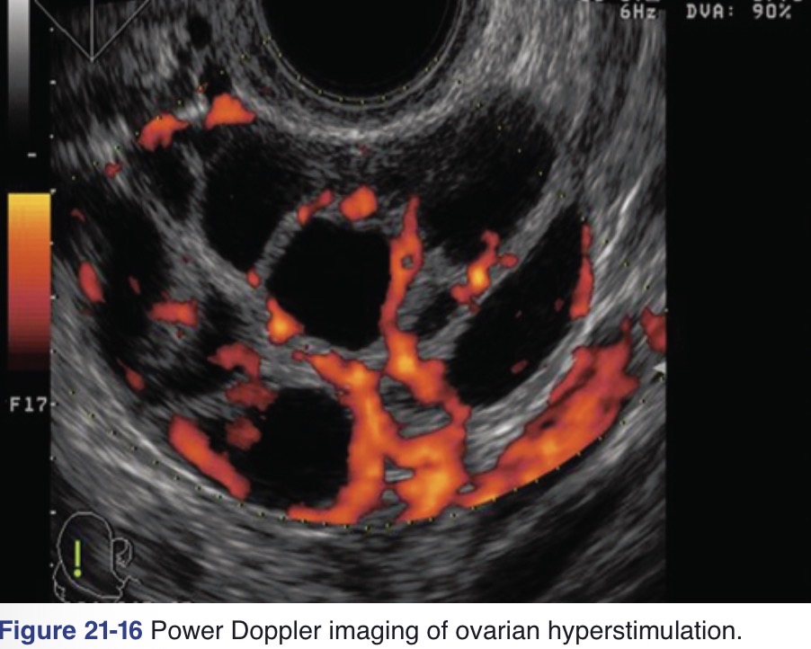 <p>Cystic enlargement of the ovaries greater than 5 cm</p><p>Ascites</p><p>Possible pleural effusion</p>