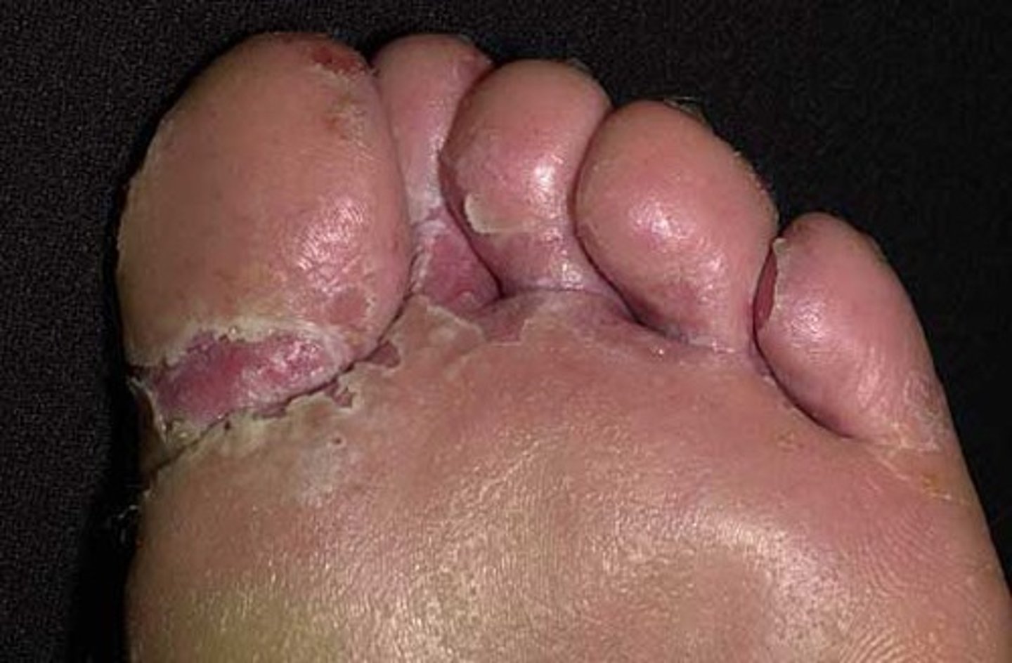 <p>A fungal infectious disease that affects humans</p><p>- Lives in damp areas on feet</p><p>- Diagnosed through observation</p><p>- Prevented through hygiene and drying feet properly</p>
