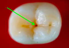<p>Pinpoint hole in the fossa or elsewhere on a tooth.</p>