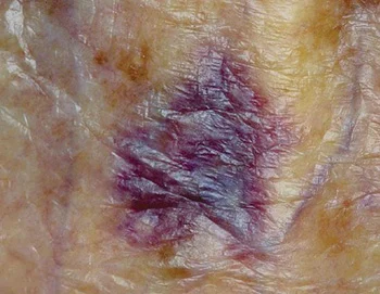 <p>Purpura (vascular lesion)</p>