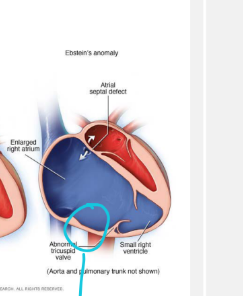 <p>Ebstein’s anomaly is a rare congenital heart defect in which the <strong>septal and posterior tricuspid valve leaflets are displaced toward the apex</strong>. producing variable degrees heart failure</p>