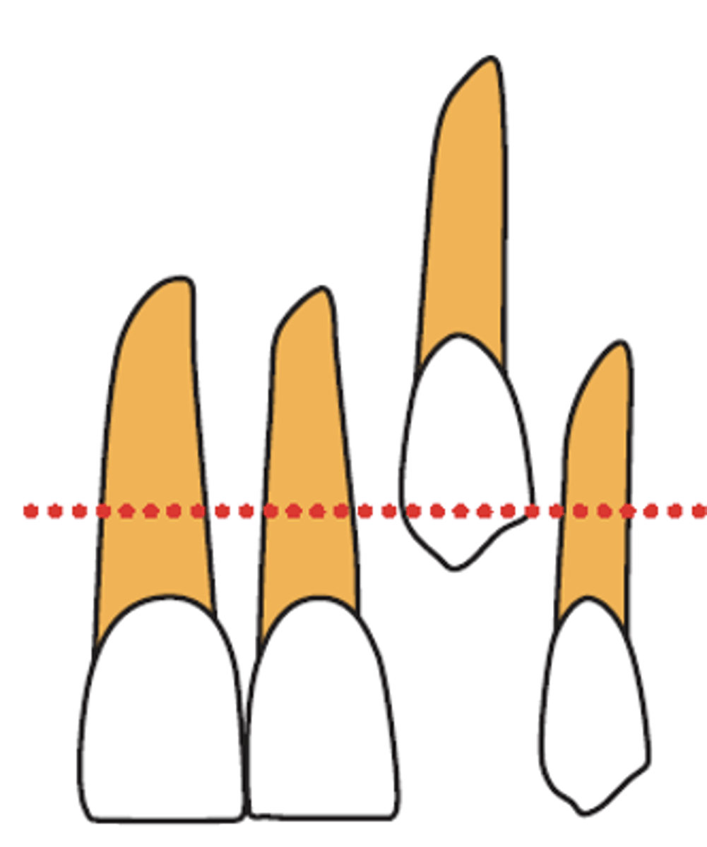 <p>What surgical technique is recommended?</p><p>- Canine cusp is<strong> apical </strong>to the mucogingival junction (MGJ)</p>