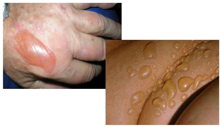 <p>skin lesion = </p>