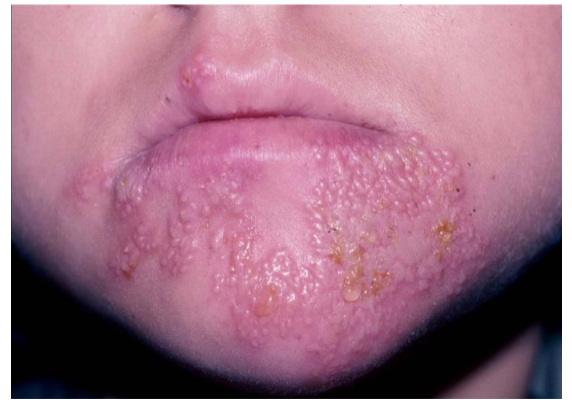 <ol><li><p>skin lesion =</p></li><li><p>filled with ______ serous fluid</p></li></ol><p></p>