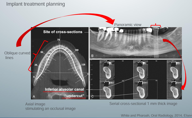 <p>-axial and panoramic images are used as reference images to show the location of the cross-sectional images</p><p>-cross-sectional images demonstrate the amount of undercut and location of the inferior alveolar canal</p><p>-can draw a panoramic curve or be as creative as we like for the clinic scenario</p><p>-draw different planes in any direction through the site of interest &amp; image quality is not degraded because of these isotropic voxels</p>