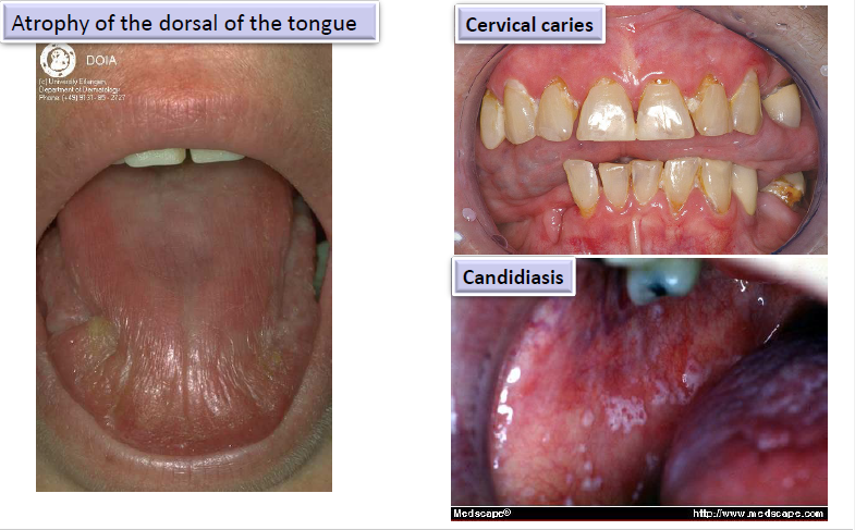 <ul><li><p>atrophy of the dorsal surface of the tongue</p></li><li><p>cervical caries</p></li><li><p>candidiasis </p></li></ul><p></p>