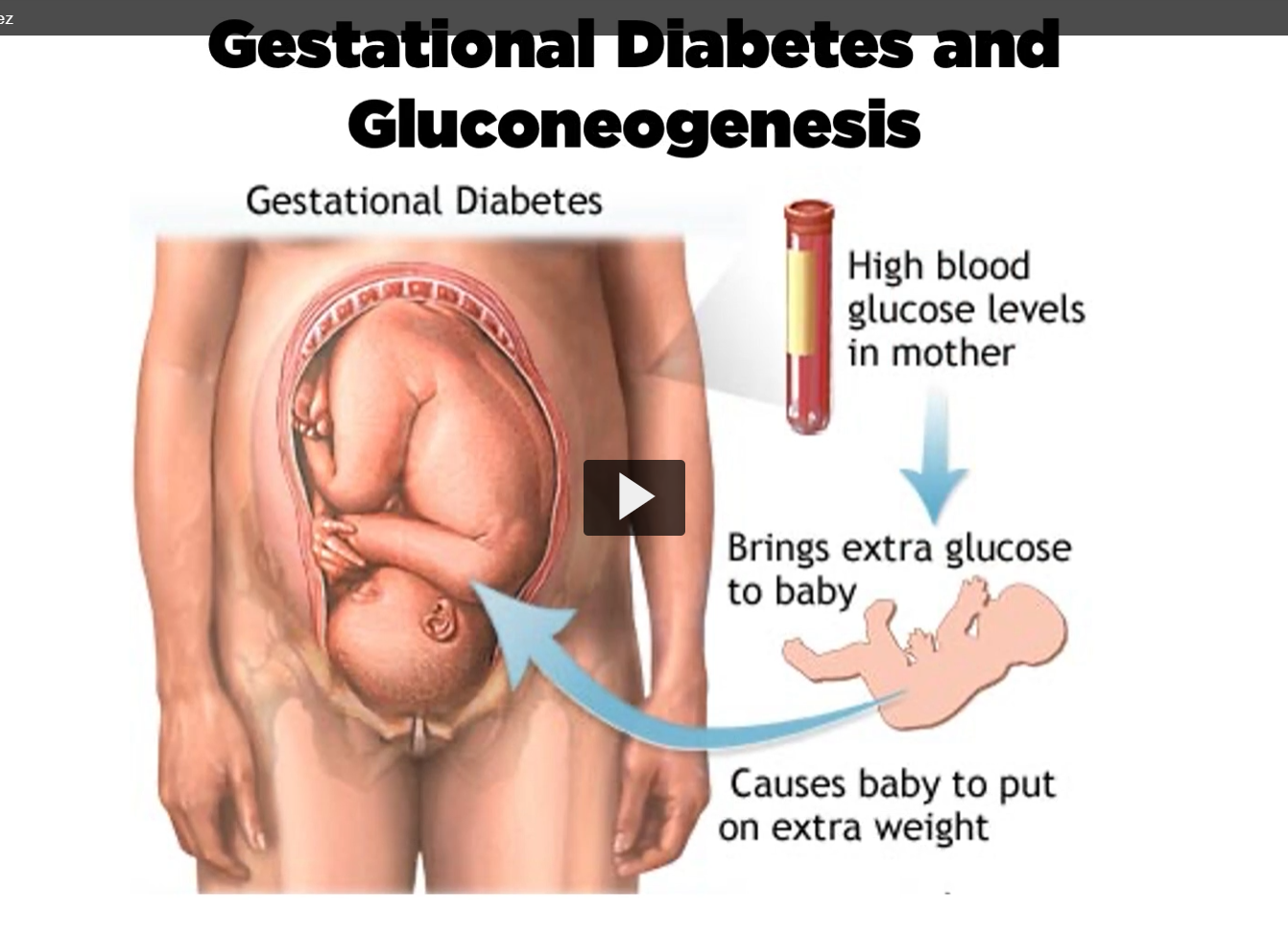 <p><u>gestational diabetes and gluconeogenesis</u></p><p>the clinical correlation for gluconeogesis is gestational diabetes</p><p>when mothers who are pregnant have high blood glucose levels, this can cause severe consequences for the fetus. </p><p>high blood glucose levels from the mothers blood means a fed state in the uterine environment of the fetus (extra glucose). </p><p>as a result, upon birth, the environment drastically changes for the neonate, and is now not receiving the levels of glucose flowing from the mothers blood. </p><p>under starving conditions, the neonate will need to start gluconeogenesis, because of this process maybe delayed in the neonate who has been enriched with high blood glucose levels during term, it can result in <strong>hypoglycemia</strong>. </p>