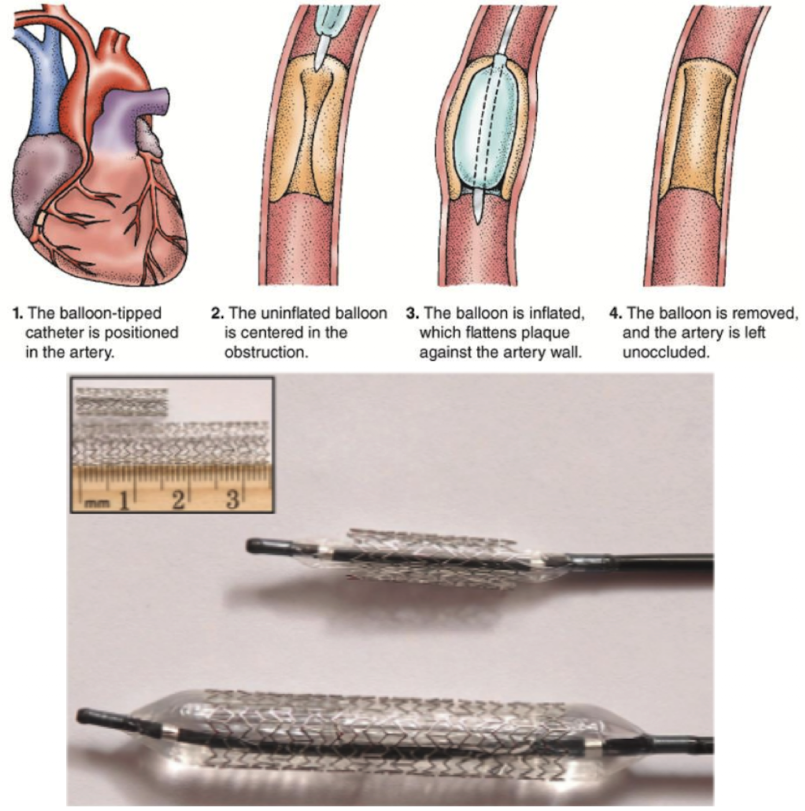 <p>Percutaneous transluminal angioplasty (PTA) &amp; stent placement</p>