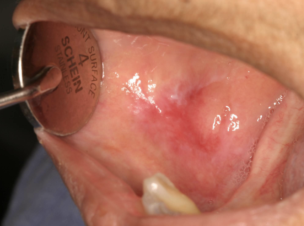 <p>what condition?</p><p>• Often symptomatic</p><p>• Striae at periphery of erythema</p>