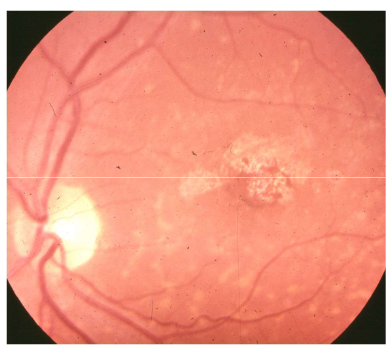 <p>Name the condition</p>