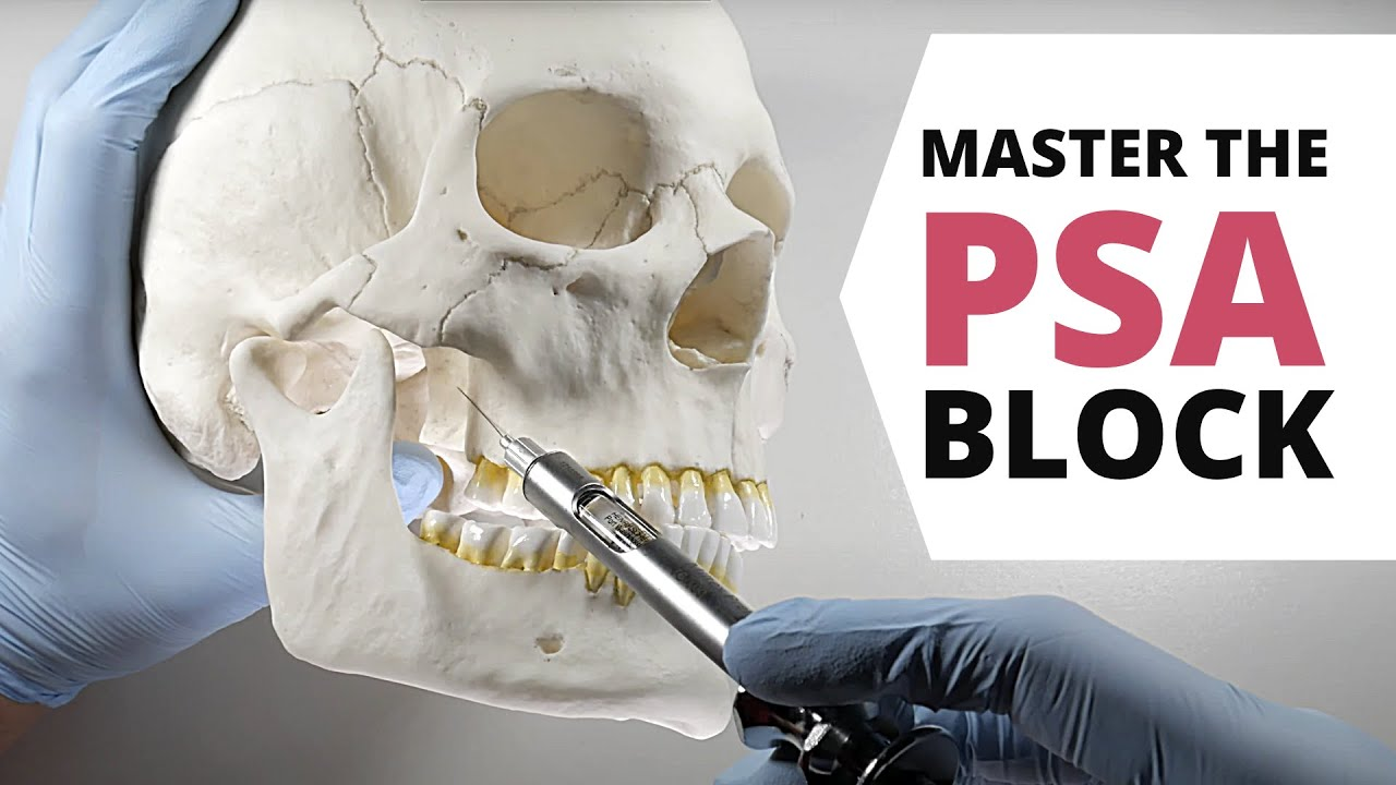 <p>What landmarks are anesthetized with a PSA block?</p><p>teeth & tissues</p><p></p>