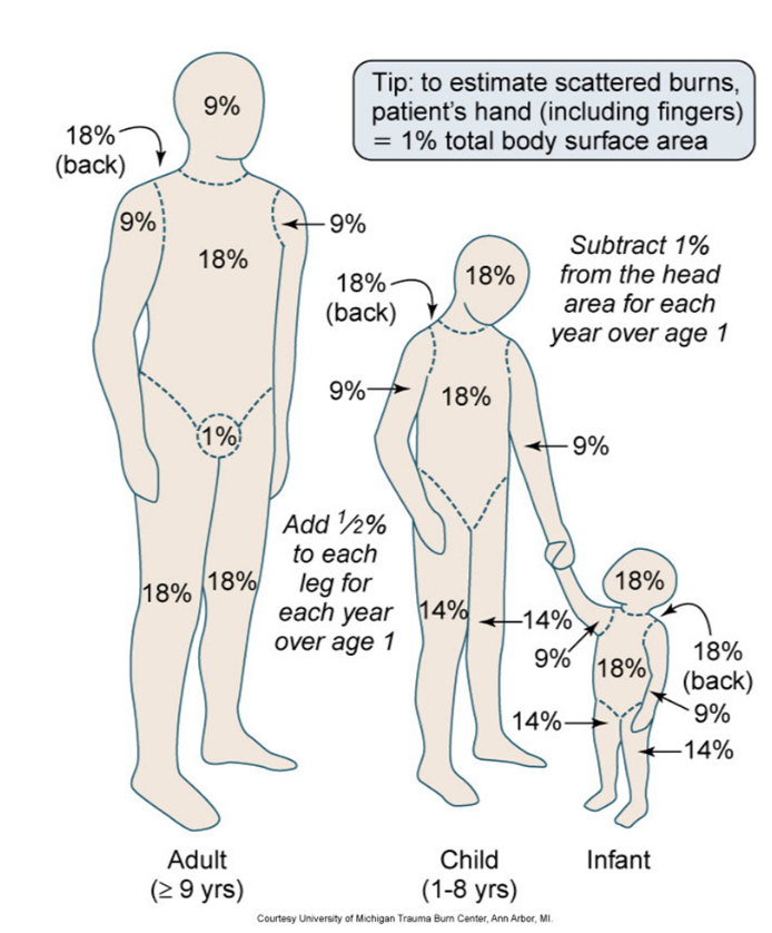 <p>rule of nines </p><ul><li><p>only used for partial and full thickness burns </p></li></ul><p></p>