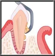 <p>"flap surgery"</p>