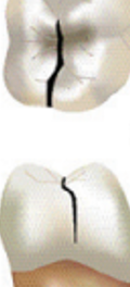 <p>A thin surface disruption of enamel and dentin, and possible cementum, of unknown depth or extension</p>