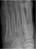 <ul><li><p>Occurring when torque is applied along the axis of a bone</p></li><li><p>While torsional forces are being applied along the parallel axis of a bone, planes perpendicular to this axis are not affected</p></li><li><p>Tension is exerted upon on part of the bone, while compressive forces are exerted upon the other</p></li><li><p>When these forces have exceeded the limit tolerable by the bone, fracture occurs</p></li></ul><p></p>