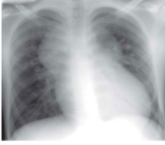 <p>CXR sign of total anomalous pulmonary venous return</p>