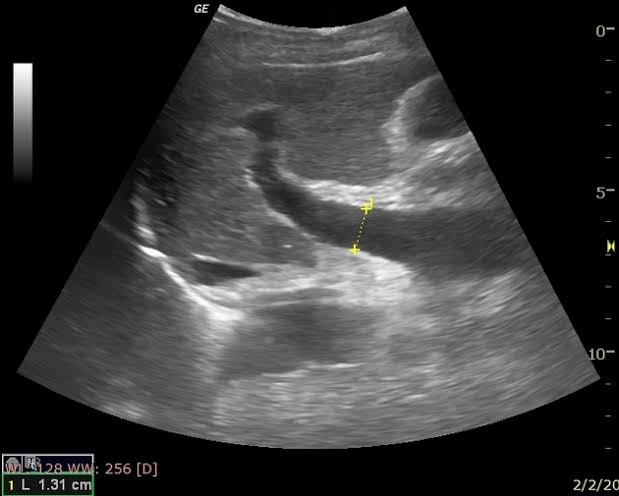<p>sonographic findings for portal hypertension</p>