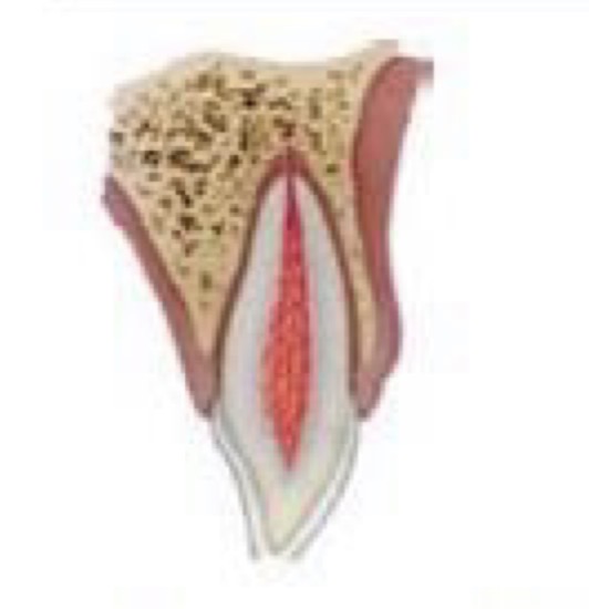 <p>A coronal fracture involving enamel only, with loss of tooth structure</p><p>If tooth fragment available if can be bonded back to tooth </p><p>Depending on extent and location- tooth edges can be smooth or composite can be placed</p>