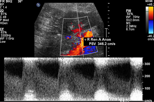 <p>elevated velocity in the main renal artery and parvus/tardus pattern in intrarenal arteries. must evaluate prox, mid, and dist segments of all types of arteries in the kidney (<span>segmental, interlobar, and arcuate arteries)</span></p>