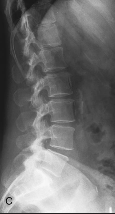 <p>Lateral L-Spine: Is this Image Good?</p>
