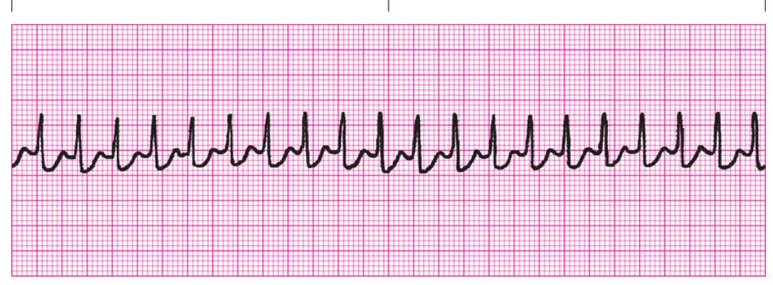 <ol><li><p>Regularity?</p></li><li><p>Rate</p></li><li><p>P Waves</p></li><li><p>PRI</p></li><li><p>QRS</p></li><li><p>Interpretation</p></li></ol><p></p>