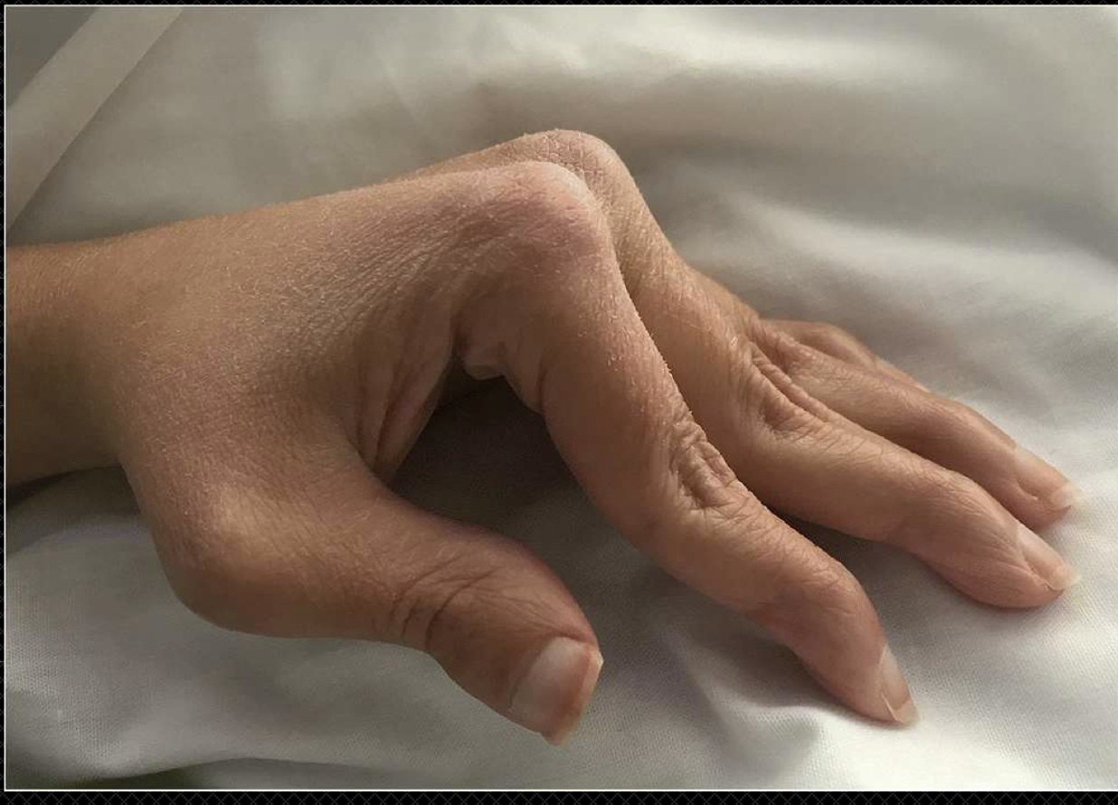 <p>SLE in hands</p>