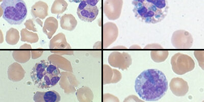 <p>RBCs become spherical and toxic changes to neutrophils (<strong>blue-green crystals of death</strong>)</p>