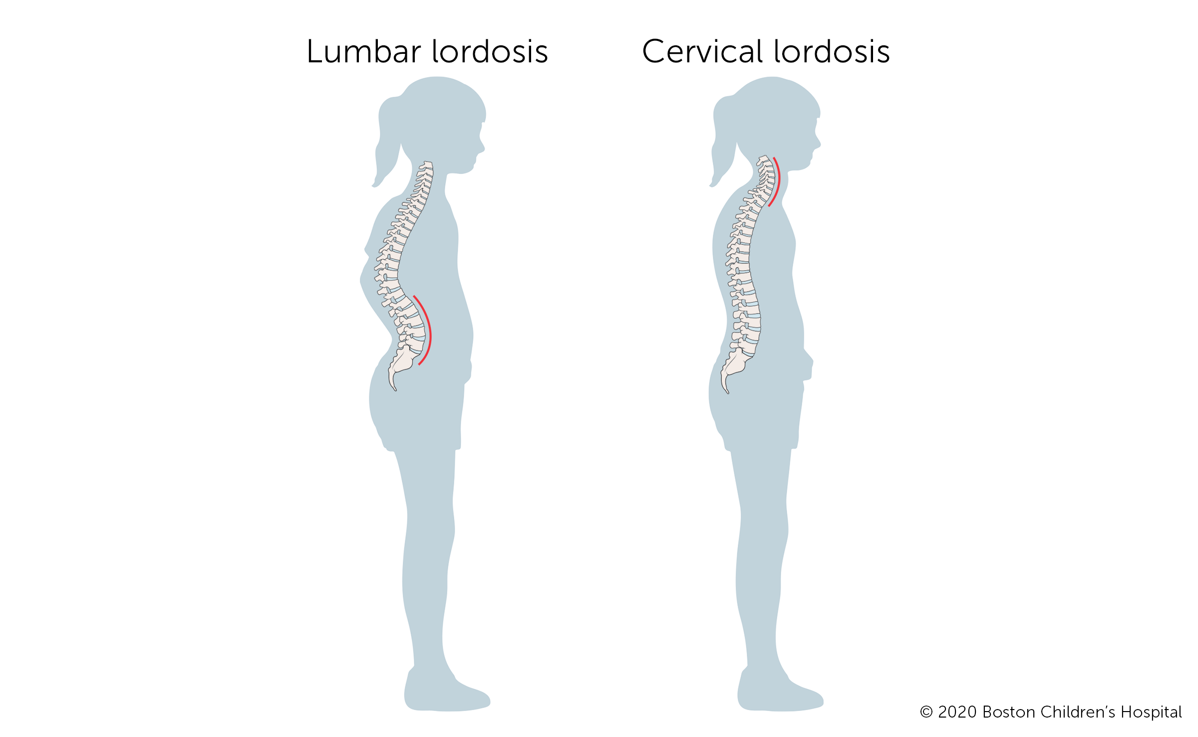 <p>Describe lordosis. (Swayback)</p>
