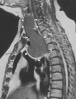 <p><span style="line-height: inherit; font-size: inherit;">A <strong>thyroid goiter</strong> is an enlargement of the thyroid gland that causes swelling in the anterior neck. This type of goiter is also called a nontoxic goiter, as it is not related to overproduction of thyroid hormone or malignancy.</span></p><p><strong>Appearance on MRI:</strong></p><ul><li><p><span style="font-family: inherit; line-height: inherit; font-size: inherit;">•</span></p><p><span style="line-height: inherit; font-size: inherit;"><strong>Normal thyroid gland</strong> appears with <strong>intermediate signal on T1-weighted images.</strong></span></p></li><li><p><span style="font-family: inherit; line-height: inherit; font-size: inherit;">•</span></p><p><span style="line-height: inherit; font-size: inherit;"><strong>Normal thyroid gland</strong> appears with <strong>higher signal on T2-weighted images.</strong></span></p></li><li><p><span style="font-family: inherit; line-height: inherit; font-size: inherit;">•</span></p><p><span style="line-height: inherit; font-size: inherit;"><strong>T2 weighted imaging</strong> is also good for <strong>evaluating compression </strong>or<strong> deviation of the trachea </strong>and<strong> intrathoracic extension of the goiter.</strong></span></p></li></ul><p></p>