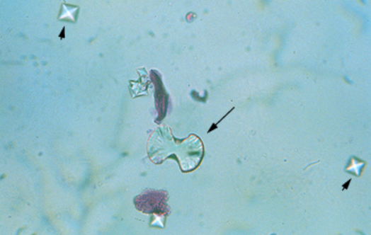 <p>Normal and Abnormal Crystals</p><p>Acidic to Normal Urine</p><p>Dihydrate-Envelopes</p><p>Monohydrate- Dumbells</p>