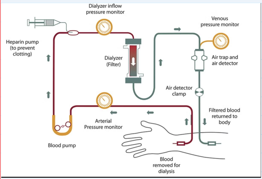 <ul><li><p><span>Dialyzer removes waste and extra fluid</span></p></li><li><p><span>Filtered blood goes back into body</span></p></li><li><p><span>Mainly done at a centre</span></p></li><li><p><span>Takes 4 hours and done 3x a week</span></p></li><li><p>Vascular access site surgery is done to open up blood vessel</p></li></ul><p></p>