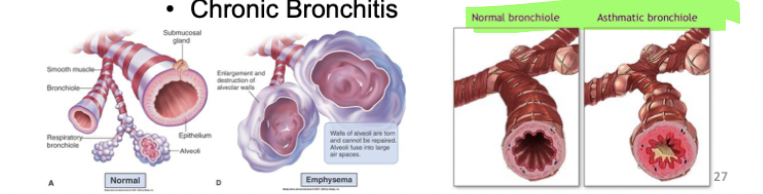 <p>ALL OBSTRUCTIVE </p><ol><li><p>asthma > bronchial smooth muscle contracts (bronchoconstriction)</p></li><li><p>chronic obstructive pulmonary disease (COPD) </p></li></ol><p>A. emphysema > loss of elastic tissue = loss of radial traction = airway collapse = increased resistance </p><p>B. chronic bronchitis > bronchi are chronically inflamed > increased resistance </p><p></p>