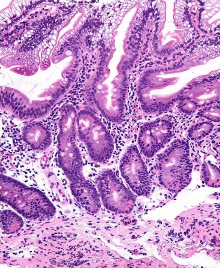 <p>Q2-Abetalipoproteinemia is a rare, inherited disorder that is caused by changes (mutations) in the microsomal triglyceride transfer protein (MTTP) gene. The disorder affects fat absorption by the intestine and mobilization by the liver. Analyze Figure 7, Abetalipoproteinemia Biopsy from the Duodenum. What changes do you see in the tissue? Explain how those changes would cause impaired fat absorption.</p><p><span style="line-height: inherit; font-size: inherit;"><strong>HINT</strong></span><span style="line-height: inherit;">: Look closely at the villi and enterocytes</span></p>