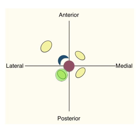 <p>Starting in LUQ and going clockwise: musculocutanous, median, ulnar, and radial.</p><p>Radial nerve was missed (AEB senation in the web space between thumb and index finger)</p>