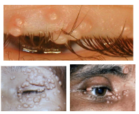 <p>What is the most likely diagnosis ?</p>