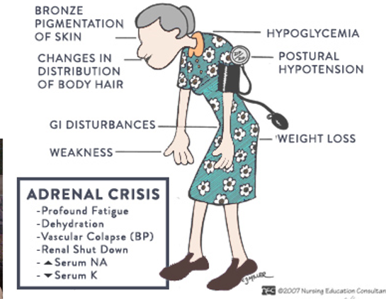 <p>disorder that develops when the adrenal glands fail </p><ul><li><p>Chronic shortage of glucocorticoids and sometimes mineralocorticoids </p></li><li><p>May develop from lack of ACTH or lack of response to ACTH</p></li><li><p>Symptoms</p><ul><li><p>Weight Loss</p></li><li><p>Fatigue</p></li><li><p>Weakness</p></li><li><p>Hypotension</p></li><li><p>Skin Darkening</p></li></ul></li><li><p>Treatment</p><ul><li><p>Therapy with oral corticosteroids</p></li></ul></li></ul><p></p>