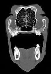 <p>WHITE- blocking x-ray from detector</p><p>Highest HU values (bone, metal)</p>