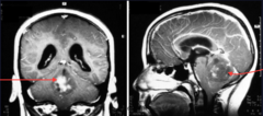<p>The Purkinje cells produce the mitogen, Shh, while the granule cell progenitors express the Shh receptors, patched.</p><p>Mutations in patched results in uncontrolled cell production of granule cells in cerebellum.</p>
