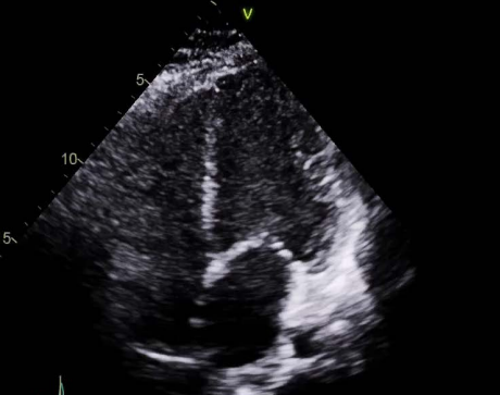 <p>Diagnosis- myocarditis and multisystem inflammatory syndrome secondary to covid-19</p>