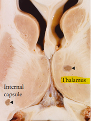 <p>What deficits can lacunar infarcts in the thalamus cause?</p>