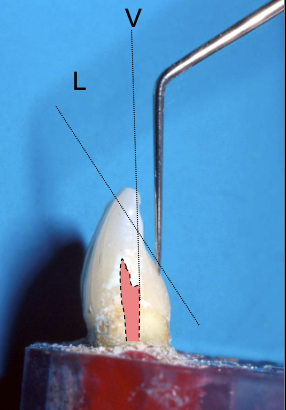 <p>The access outline is determined by the “incisal limit.” What does this mean?</p>