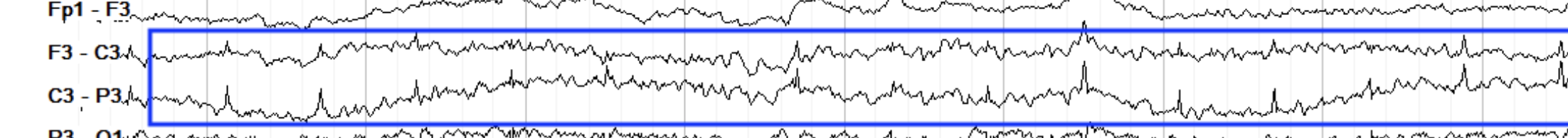 <p>sl,ow undulating <.5Hz</p>