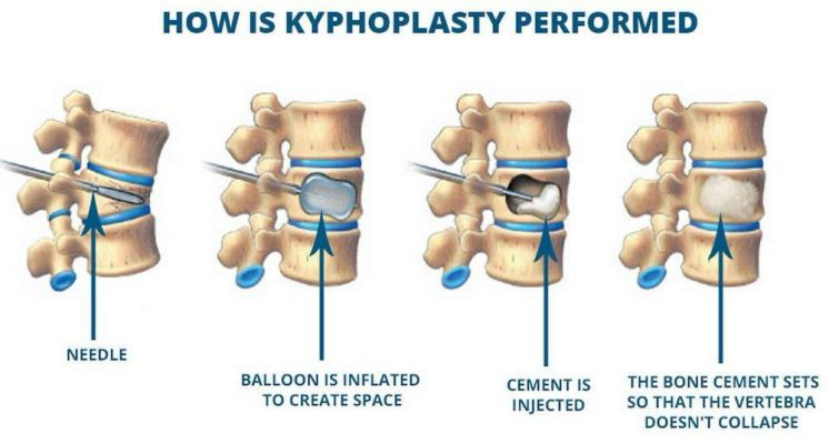 <p>Balloon-assisted vertebroplasty</p>