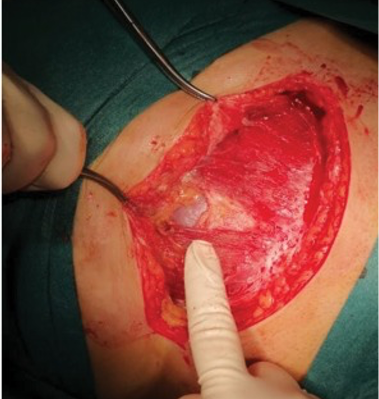 <ul><li><p><span><span>Rectus muscles separated in midline</span></span></p></li><li><p><span><span>Enter peritoneum carefully (bladder could be there)</span></span></p></li><li><p><span><span>Extend peritoneal opening</span></span></p></li><li><p><span><span>Now the abdomen is entered</span></span></p></li></ul><p></p><p></p>