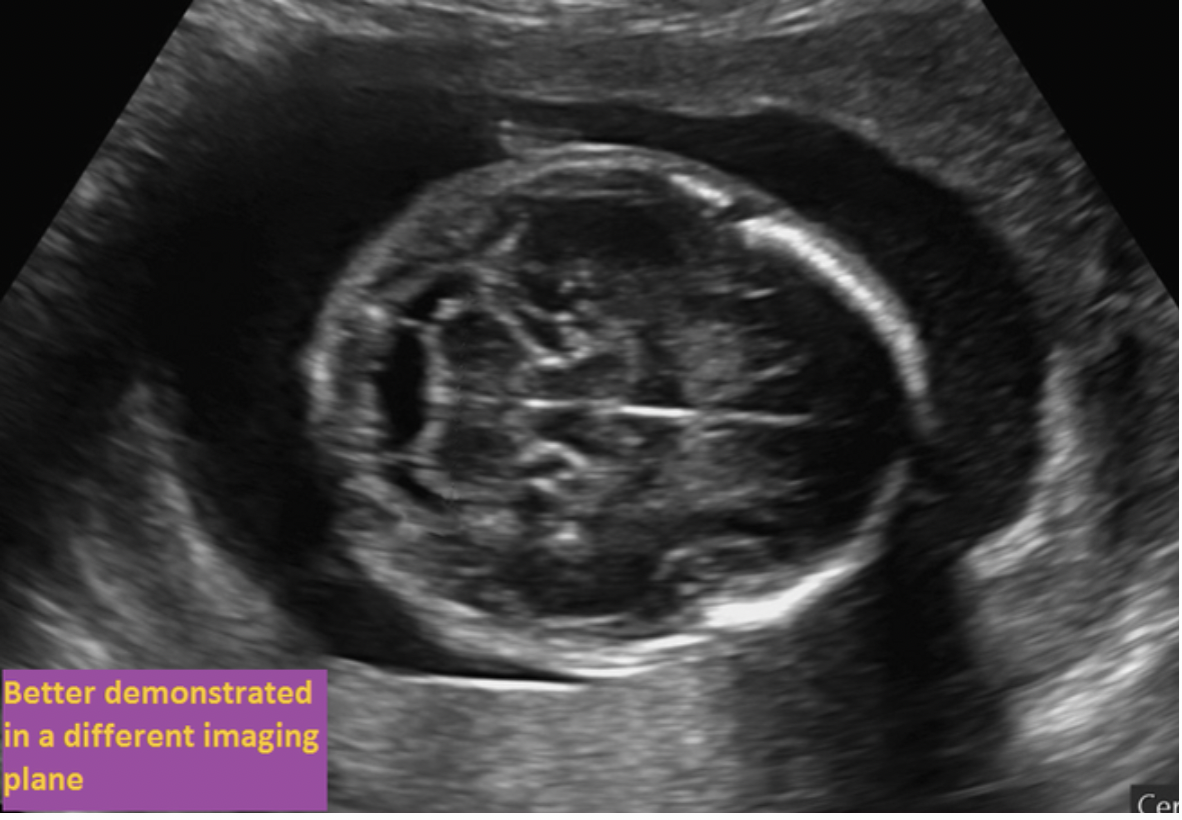 <p>If the fetus is in breech position, where is the left lobe of the thalamus located. If the structure is normally evaluated in a different imaging plane, select the purple box</p>